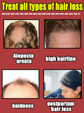 Hair growth essential oil, treatment for hair loss, baldness